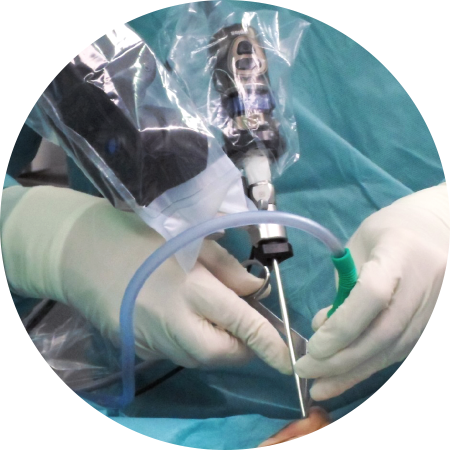 Nose surgery with ENDOFIX exo