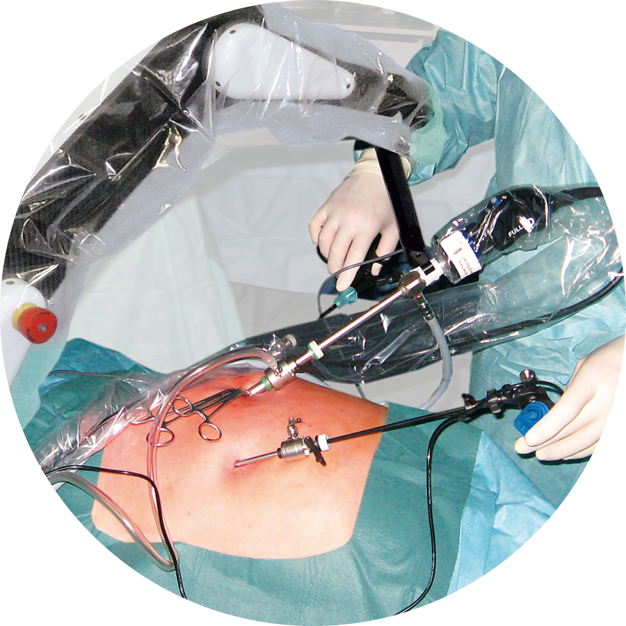 inguinual surgery with SOLOASSIST II